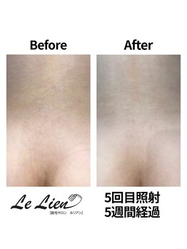 ルリアン(Le Lien)/【レディース】腰回り症例