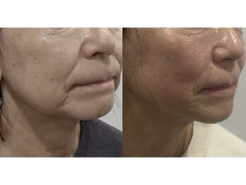 スキンスタジオ レア(Lea)/韓国オンダリフト