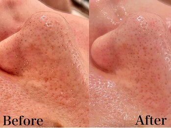 銀座ナチュラル スタイル (Natural Style)/黒ずみ・角栓汚れに/毛穴洗浄