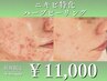 【実績多数◎】ニキビケア特化したハーブピーリング￥15,400→￥11,000