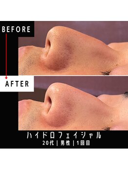 東京デトックス/ハイドロフェイシャルケア