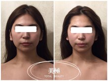 美極 銀座店/銀座/小顔コルギ/小顔矯正