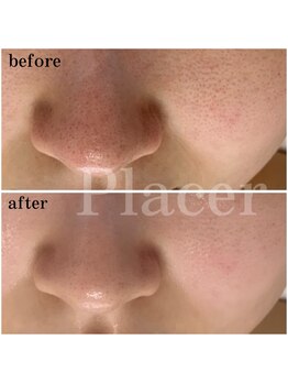 プラセル(Placer)/原因を見極めて