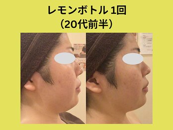 アユアランリンク 札幌店/レモンボトル/20代前半/1回