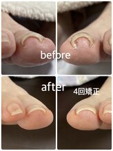 フロー(Froh)/挟み込んだ巻き爪