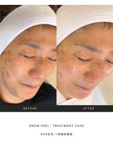 スキンラウンジ(SKIN LOUNGE)/韓国肌管理｜PDRN雪花ピール