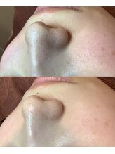 【バイオピーリング×光フェイシャル】満足度NO．１！施術後すぐに実感して頂ける！ビフォーアフター