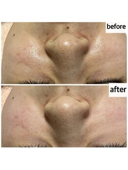 メナードフェイシャルサロン 岐阜茜部/毛穴ケア/くすみ/乾燥