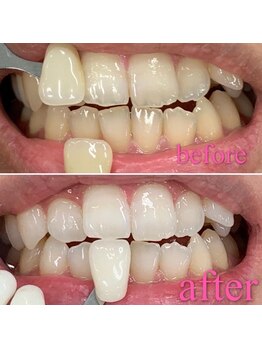 ワイズサロン(Y's salon)/数回のホワイトニングの症例