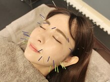 サボ 表参道 原宿(SABO)/美容鍼で小顔｜美容鍼×整体SABO