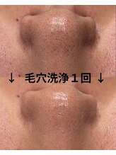 バディーズ(BUDDieS)/メンズ専門ハイドラ毛穴洗浄