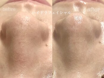 キアラ(CHIARA)/ハイドラフェイシャル