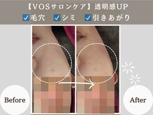 アンジュ(ANGE)/VOSサロンケア症例シミ