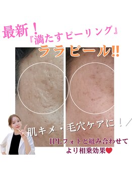 ダイヤ 名古屋中川区店(Daiya)/■ララピール【Before&After】