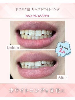 エクシアホワイトニング 江坂店/ビフォーアフター