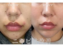 リツイート(ReTweet)/HAABREPROハーブピーリング