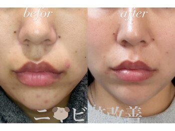 リツイート(ReTweet)/HAABREPROハーブピーリング