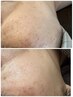 【医療提携!効果実感を◎】 シミケア プラズマニア+美容液導入+パック付き