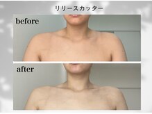 セレンディピティー(Serendipity)の雰囲気（巻き肩気味のラインを整え、首からデコルテまで美しく！）