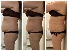 ソルニス(Solnis.)/痩身☆脂肪分解/ハイパーナイフ