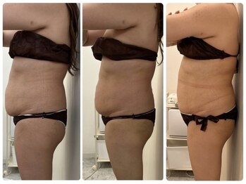 ソルニス(Solnis.)/痩身☆脂肪分解/ハイパーナイフ