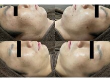 ラヴィアンローズ 泉店 (La vie en Rose)/イロンハーブピーリング