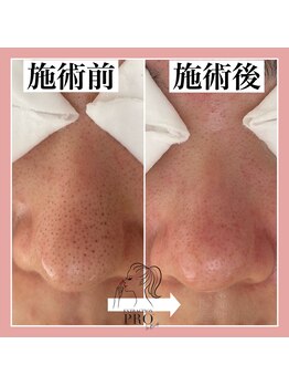 シェリー(Cherie)/毛穴の黒ずみ綺麗にします