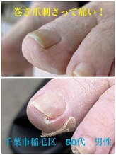 巻き爪じゅん 千葉駅前店/巻き爪が刺さったみたいでツラい