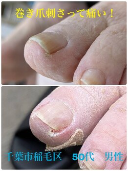 巻き爪じゅん 千葉駅前店/巻き爪が刺さったみたいでツラい