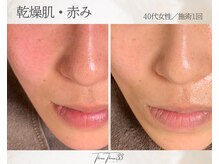 スリースリー(THREE THREE)/乾燥・赤みケア