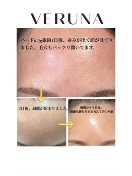 ココ 2号店(CoCo)/ハーブピーリング/ダウンタイム