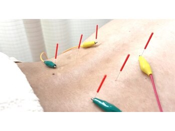 グロウアップ鍼灸整骨院 阪急茨木市駅前(GROW UP鍼灸整骨院)/頑固なコリには鍼灸施術◎