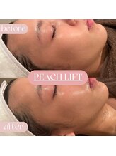 ナビ(NAVI)/韓国最新サーマジ！リフトアップ