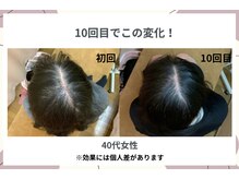 福山発毛センターの雰囲気（１０回で見え方がこんなに変わります！ー５歳若見えを目指して）