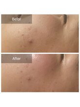 ブランスパ(Bulan Spa)/【陶肌トリートメント】