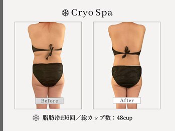 クリオスパ せんげん台駅前店(Cryo Spa)/脂肪冷却