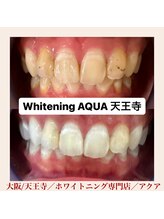 アクア 天王寺店(AQUA)/セルフホワイトニング/天王寺