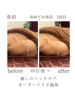 アンフィニ 麻布十番(Infini)/Before & After　《巻肩・頭痛》