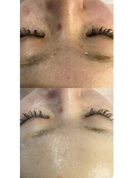 ナチュライズ(NatuRise)/ニキビケア、毛穴、肌質改善