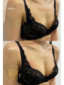 ラヴィス(RAVIS)/バストのボリューム改善