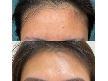 エトワール 横浜馬車道店(ETOILE)/肌質改善|毛穴ケア