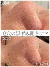 サロンドエテ(salon de ete)/毛穴ケア