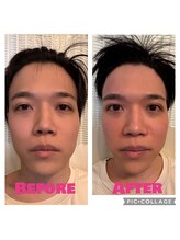 渋谷宇田川町カイロプラクティック/小顔矯正(左側だけ施術)