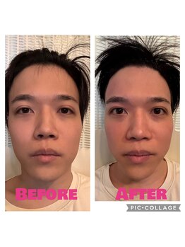 渋谷宇田川町カイロプラクティック/小顔矯正(左側だけ施術)