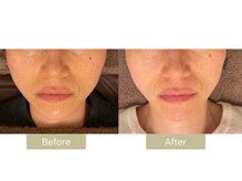 リフサロ(Rifsaro)/光フォト1回　Before/After