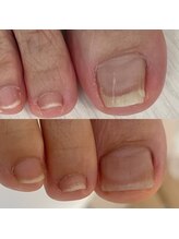 シーネイル(C Nail)/巻き爪補正1回目でこの変化！