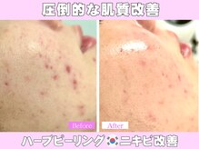 カンナムビューティー/ハーブピーリングでニキビケア