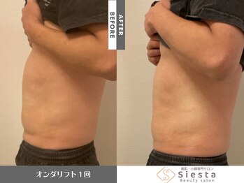 シエスタ(siesta)/韓国脂肪分解リフト ボディー