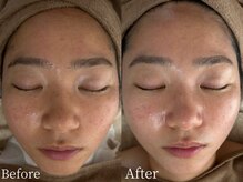 スウィート リリー(Sweet Lily)/赤み、ニキビ◎