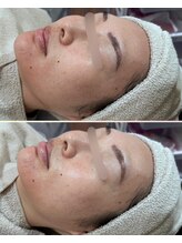 ソワナ(soina)/【神楽坂駅/フェイシャル/毛穴】